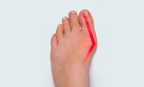 Moderate Bunion